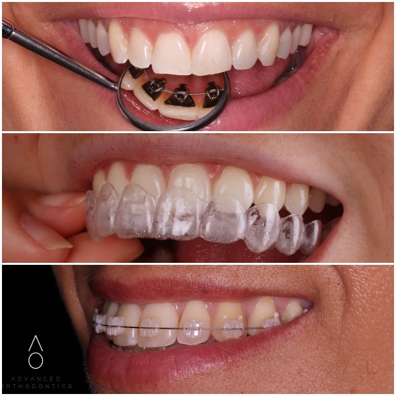 ¿Qué tipo de aparatología de ortodoncia es la mejor? ¿Y la mas eficiente?
